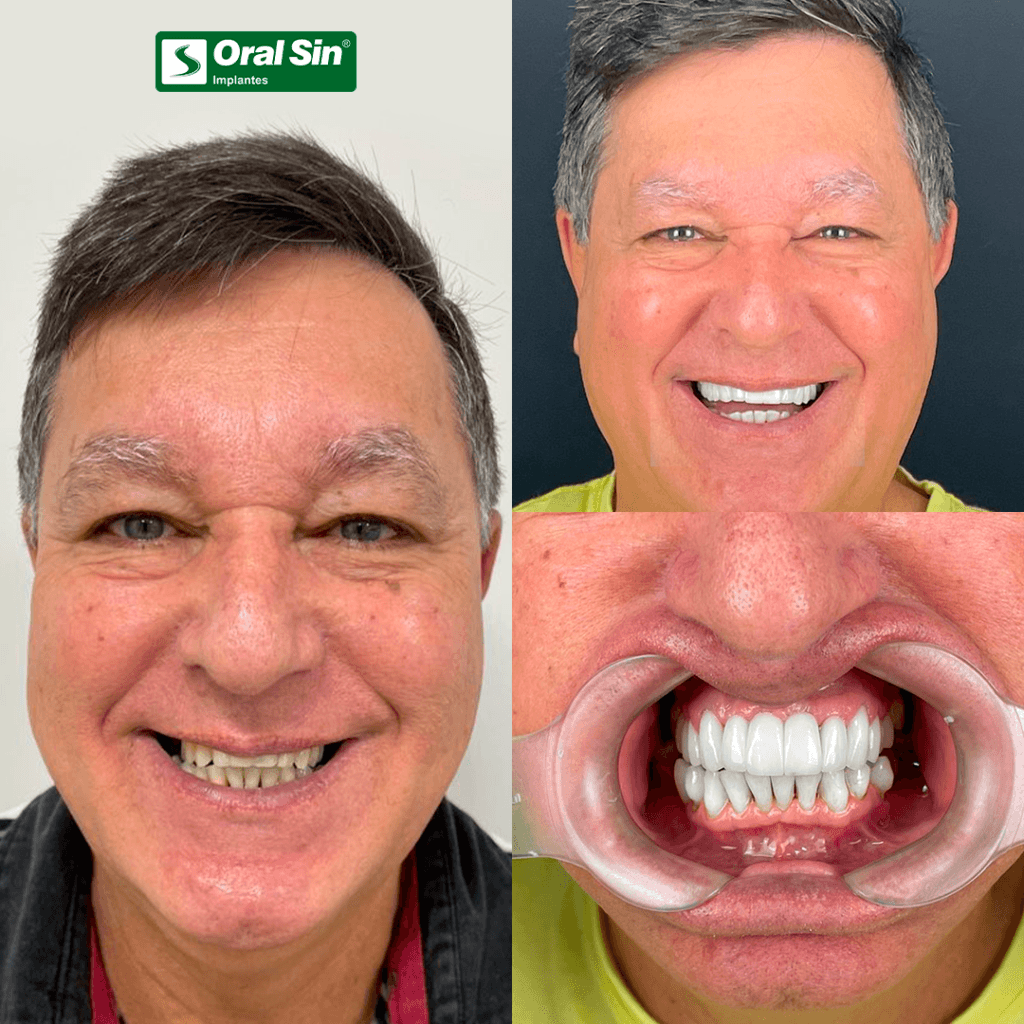 Antes & depois — caso 01